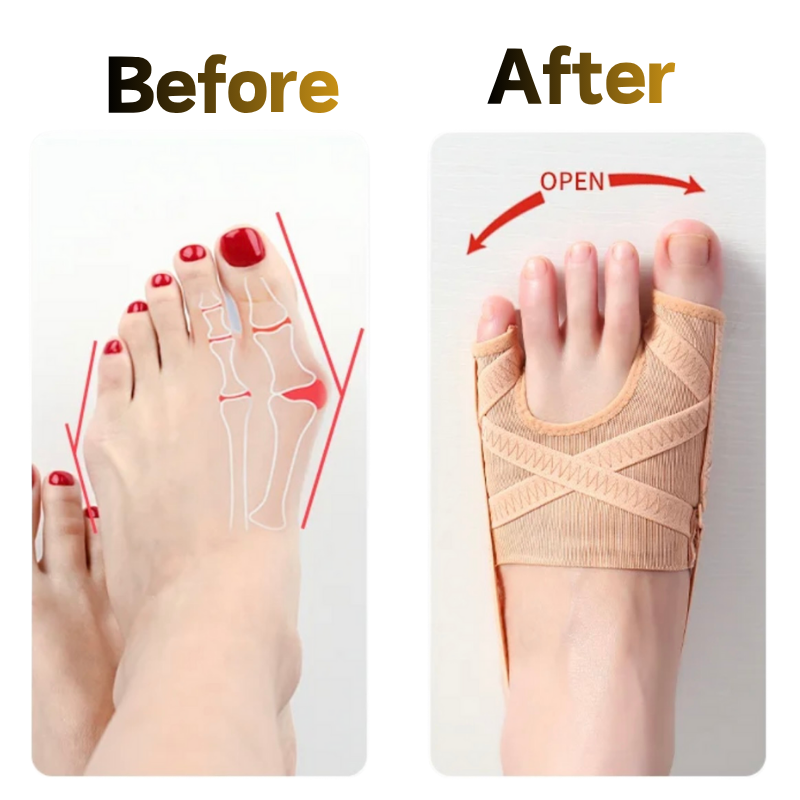 Hallux Valgus Correction